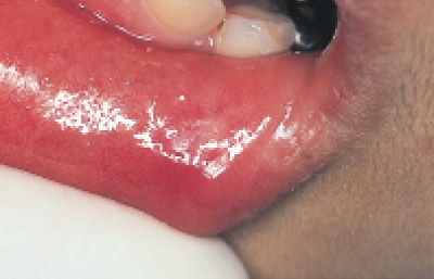 下口唇粘液嚢胞、2週後の写真