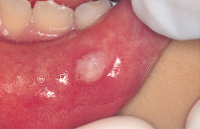 下口唇粘液嚢胞の写真