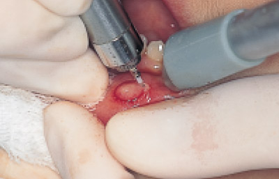 下口唇粘液嚢胞、術中の写真