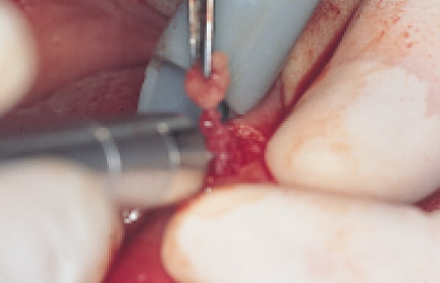 下口唇粘液嚢胞、術中の写真