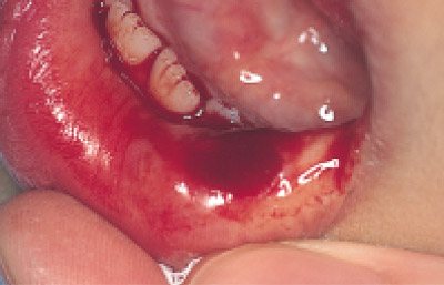 下口唇粘液嚢胞、術直後の写真