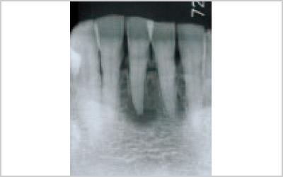 初診時X-Ray写真