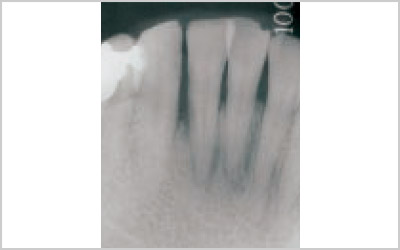 X-Ray写真