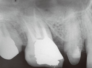 歯冠破折のため抜髄、約2年後のX線写真