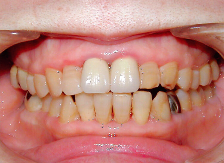 ＜症例3＞終了時口腔内はある程度きれいになっているが歯垢の付着はある。細菌叢は安定しているので、ブラッシング指導と定期的管理で維持を図る。