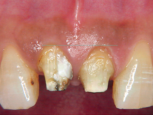 歯冠延長後の写真