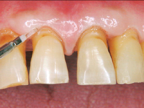 歯肉の形態修正を行う写真