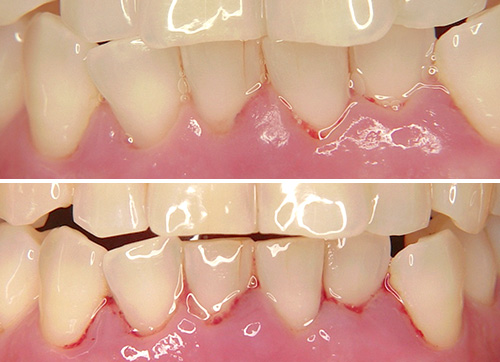 前歯部歯肉の腫れと疼痛のある患者の写真