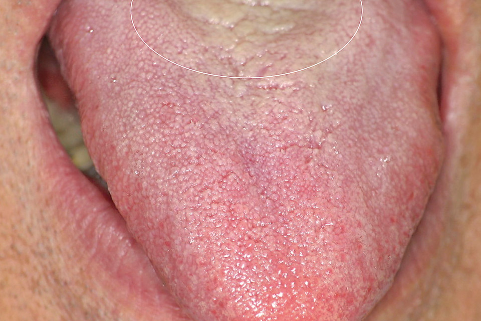図1　舌苔の例