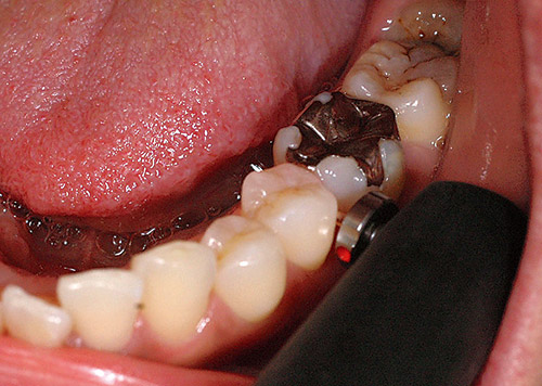 歯間部に隣接面用のライトプローブを挿入した写真