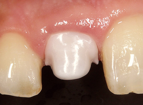 ジルコニアコーピングに支台歯のベージュ色が透けていることが観察される