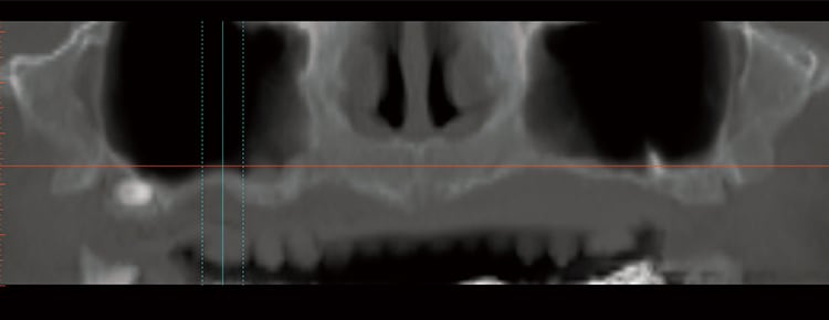 症例1：SimPlant による術前のパノラミック画像。両側のサイナスは大きく臼歯部に残存する骨高径はわずかである。