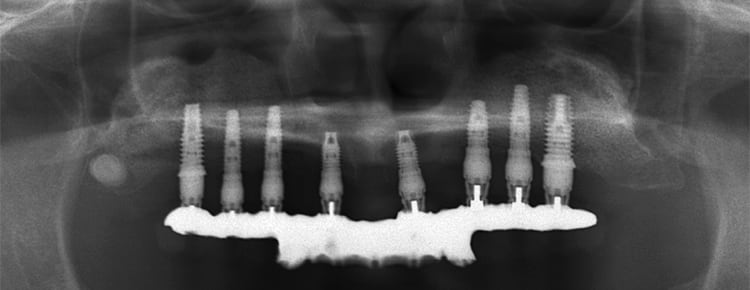 術後のパノラマ。臼歯部のインプラントはサイナスリフトによって造成された骨によって支持されている。