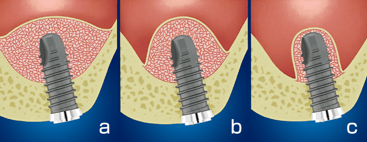 a、b、cの順でインプラント－骨界面の応力が増加する。