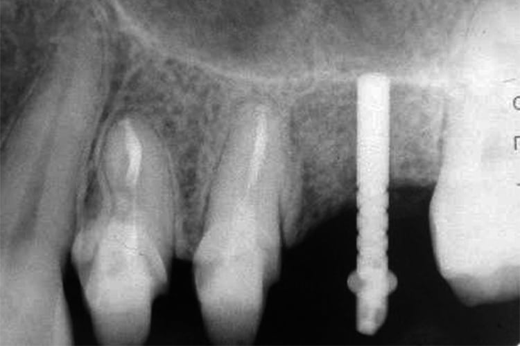 症例3：オステオトームによるソケットリフト術中のデンタル。上顎洞底に可及的に近接しオステオトームの作業長を決定する。