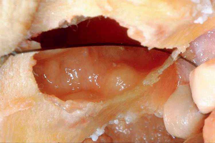 症例4：カダバーにおけるオステオトームによるシュナイダー膜の拳上状態。ソケットリフトの初期ではドーム状に拳上される。