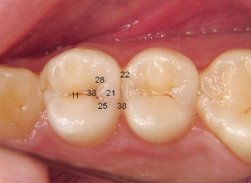ダイアグノデント ペンの数値と、Dental X‑Rayによる測定