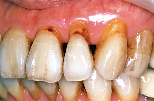 左側前歯部３歯の露出根面のう蝕の術前写真