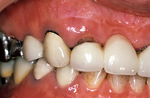 右側前歯のメタルボンド修復歯の歯頸部根面露出とう蝕の症例写真