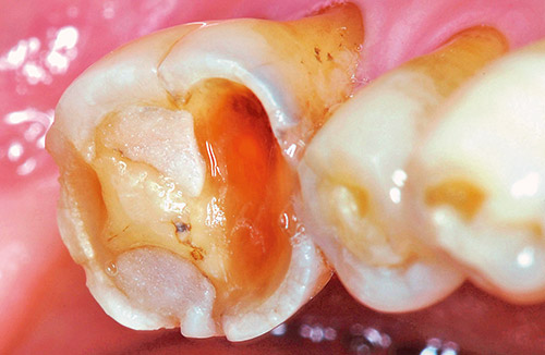 臼歯部咬耗：術前の写真
