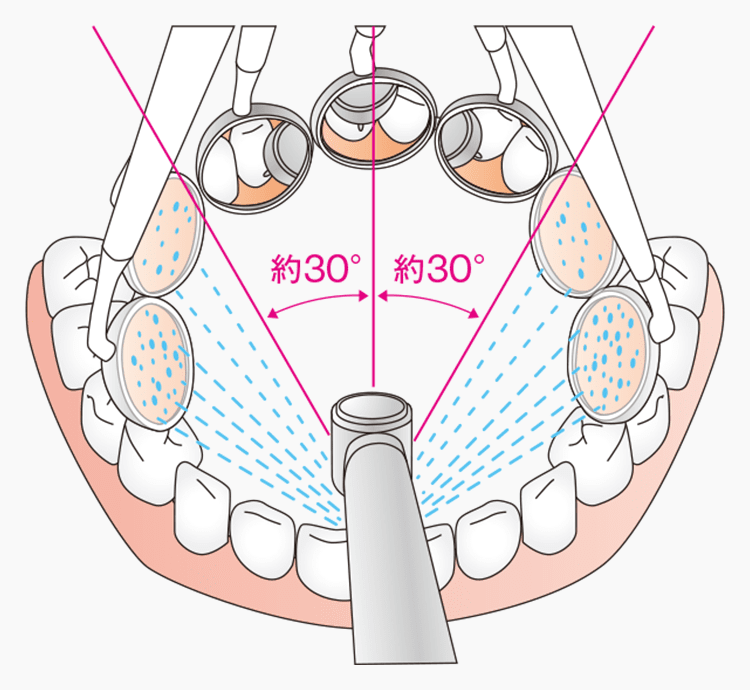 冷却水量は健全な歯質の色を識別でき、窩洞を洗浄できる十分な水量である約15cc／min.を確保