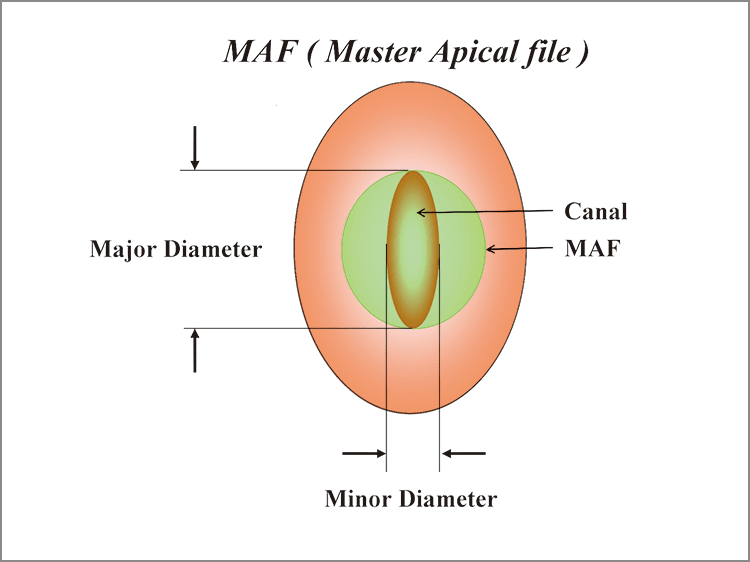 MAF ( Master Apical file ) 