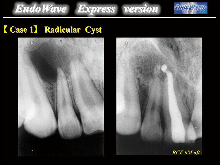 Case1 : Radicular Cyst　左図：術前では、根尖周囲に12×17 mmの根尖病変が認められる。　右図：6カ月後、歯根遠心側に軽度の外部吸収像が認められるものの、歯槽硬線は明瞭化し、歯根周囲には歯槽骨再生様の骨梁構造が認められた。