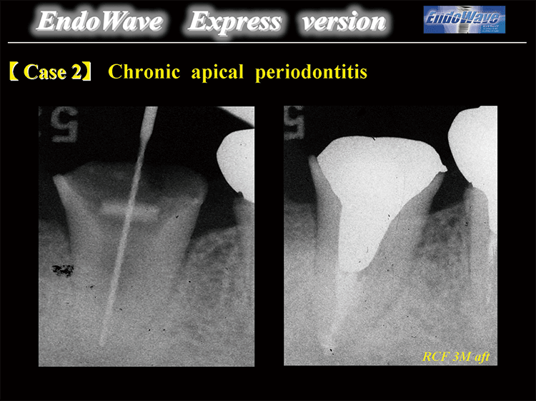 Case2 : Chronic apical periodontitis　左図：LAX #60/.‑01Tにて根尖側 1 mmアンダ－をApical preparation。　右図：当該歯は樋状根であり、根管充塡3カ月後、根尖周囲に異常所見は認められない。