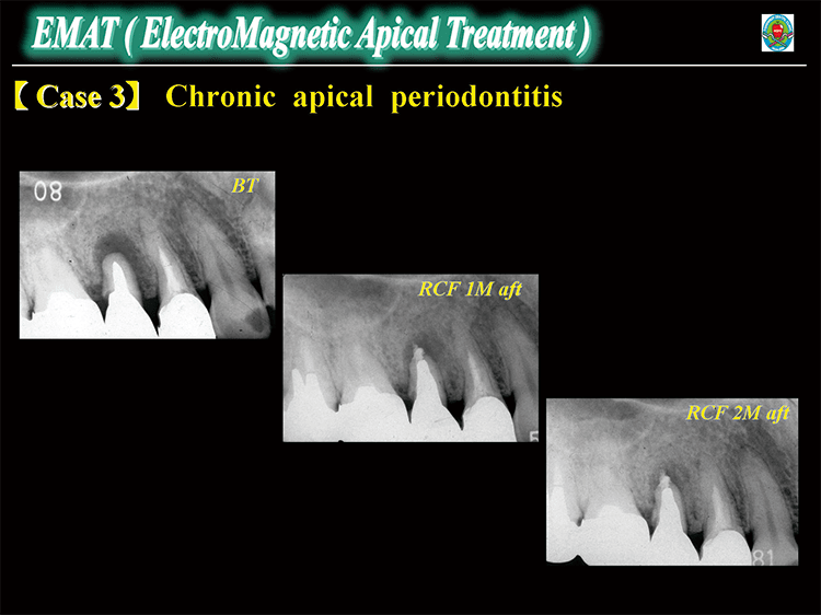 Case3 : Chronic apical periodontitis　左図：術前では、歯頸部付近に達する骨透過像が認められる。　中図：根管充塡 1カ月後、根尖病変の縮小が認められる。　右図：根管充塡 2カ月後、根管充塡材には変化は認められないが、根尖病変の治癒傾向が認められる。