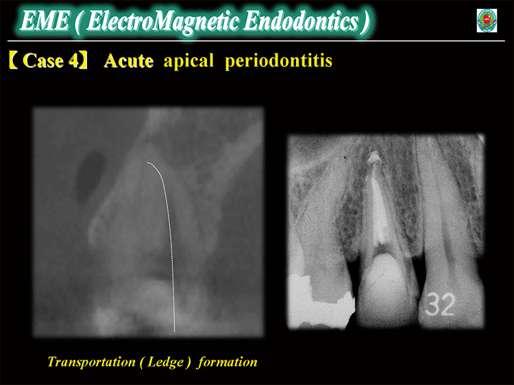 Case4 : Acute apical periodontitis　左図：術前CTでは、口蓋根管にLedge形成が認められる。　右図：Ledge直前まで#60/‑.01 LAXにて根管拡大後、代償的根管充塡を施した。