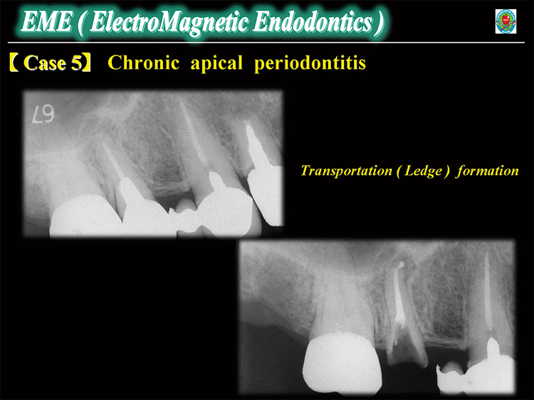 Case5 : Chronic apical periodontitis　左図：術前では、根尖周囲に5×8 mmの根尖病変が認められる。 右図：Vertical condensation にて代償的根管充塡を施した。