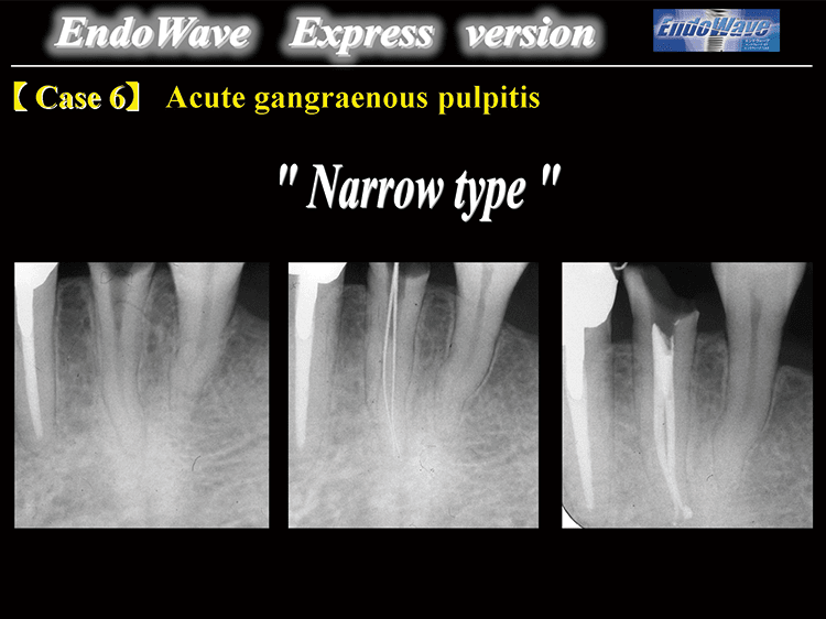 Case6 : Acute gangraenous pulpitis “Narrow type” EndoWave Express versionの#25/.04, #25/.06, #30/.06で根管形成は終了する。