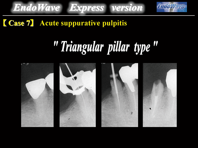 Case7 : Acute suppurative pulpitis “Triangular pillar type” #35/.04, #40/.02, #50/‑.01 LAX, #60/‑.01LAXでApical preparationを行う。