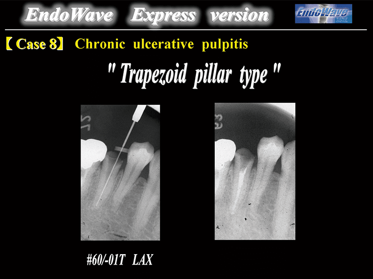 Case7 : Chronic ulceraive pulpitis “Trapezoid pillar type” 太い湾曲根管では#50/‑.01 LAX, #60/‑.01LAXが必須となる。