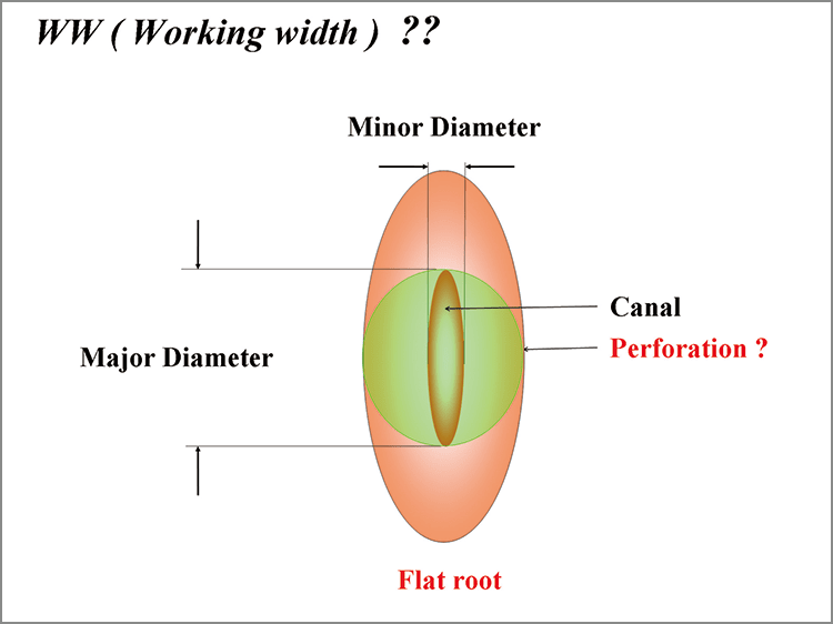 Flat root 極端な板状根、根面溝の深い根では、不注意な形成によって Strip perforation を惹起する。