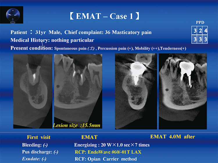 EMAT ‑ Case1 : Radicular Cyst　左図：術前CTでは、遠心根尖周囲に15.5×7.0 mmの根尖病変が認められる。　右図：4カ月後、根管充塡材のわずかな溢出が認められるものの、歯根周囲には歯槽骨再生様像が認められた。