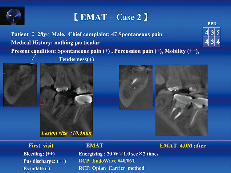 EMAT ‑ Case2 : Radicular Cyst　左図：術前CTでは、根分岐部を中心に10.5×4.0 mmの根尖病変が認められる。　右図：4カ月後、根分岐部にも歯槽骨再生様像が認められ、ほぼ生理的な状態に回復していた。