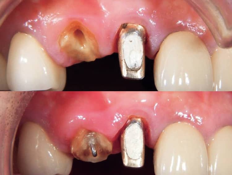 エクストルージョンを応用した例。隣在歯と調和のとれた生理的な歯周組織を獲得するために歯周外科処置の併用が必要となる場合が多い。