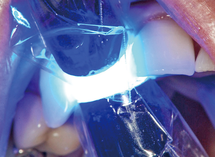 図20 光重合には照射器を2台使用している。歯随刺激を考慮して必ずエアーで冷却しながら照射する。