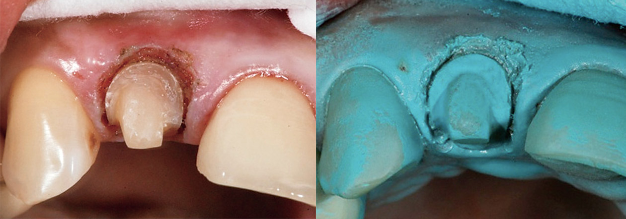 図4 ビルドアップテクニックで歯肉縁上に設定された修復物マージン。支台歯は接着を考慮したアドヒージブデザインに形成する。パウダリングを行いセレックで光学印象を行う。入院手術を控えた患者の希望は即日審美修復。