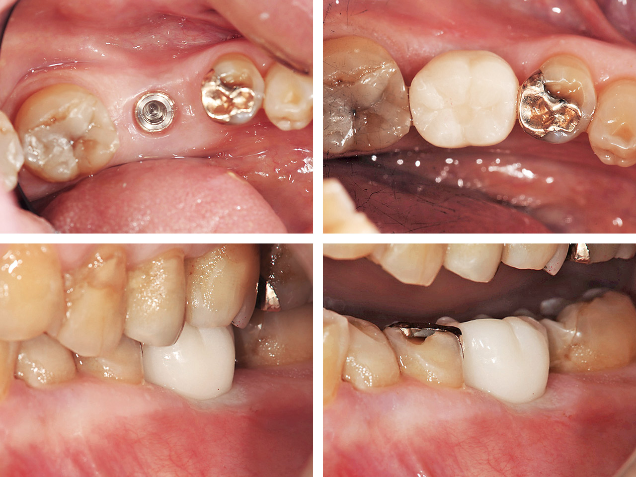 インプラント周囲歯肉の成熟とプロビジョナルレストレーション。天然歯根とはちがいインプラントは真円形である。プロビジョナルを使ってプラットフォームからクラウンの形態を考慮することにより、最終補綴物へと移行する。