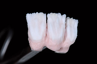 歯肉色の築盛の写真