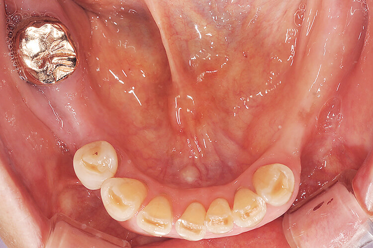 臼歯部欠損歯槽堤はやや狭小である。右側第二大臼歯は近心傾斜した状態でFCKが装着されているものの動揺度は２を超えている。残存歯列に大きな歯牙移動はみられない。