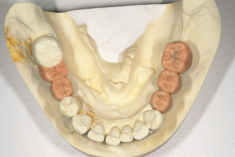 下顎欠損歯槽堤にインプラント埋入部位を決定するための指標となるワックスアップ。