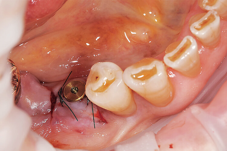 下顎右側第二小臼歯部にインプラント埋入。