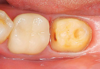 支台歯の写真