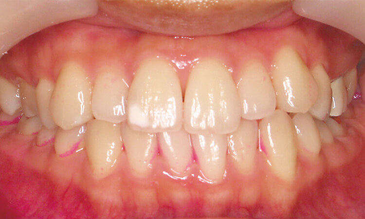 症例1：20歳代女性、自分磨き、DENT.EX systema 44H（手用）。鏡を見ずに３分間ブラッシング後の状態。かなりきれいになっているが、歯頸部、歯間部を中心に磨き残しが見られる。