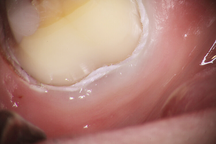 支台歯形成において、目視で確認したことにしていたマージンラインの連続性をマイクロスコープによる拡大下で、確認し修正することができる。