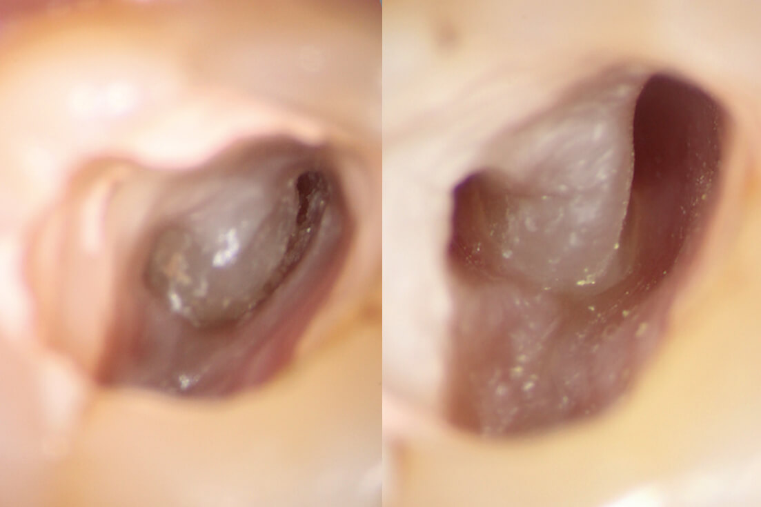 マイクロスコープの根管治療への応用。上顎左側第二大臼歯の近心頰側根をマイクロスコープ下で超音波チップを用いて選択的に歯質を落として行った根管拡大。