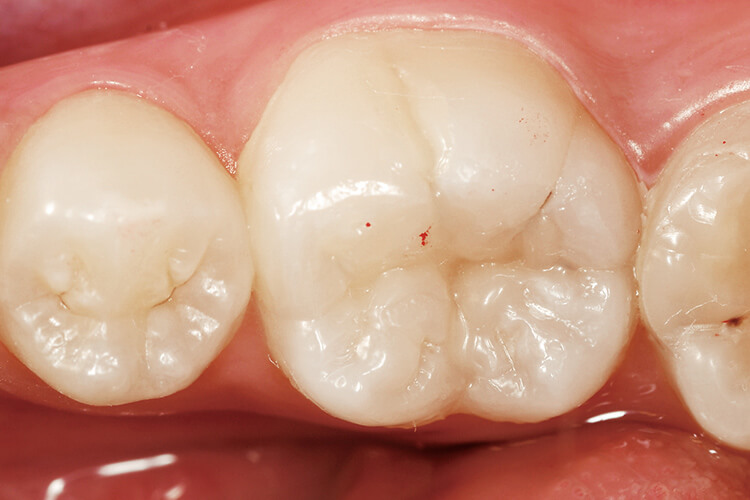 6ヵ月後の口腔内の状態。咬合接触状態を確認するために咬合紙をマーキングに用いている。 充填直後と比較して良好な状態を維持しており、表面性状に関しては、治療直後より滑沢性を増している。
